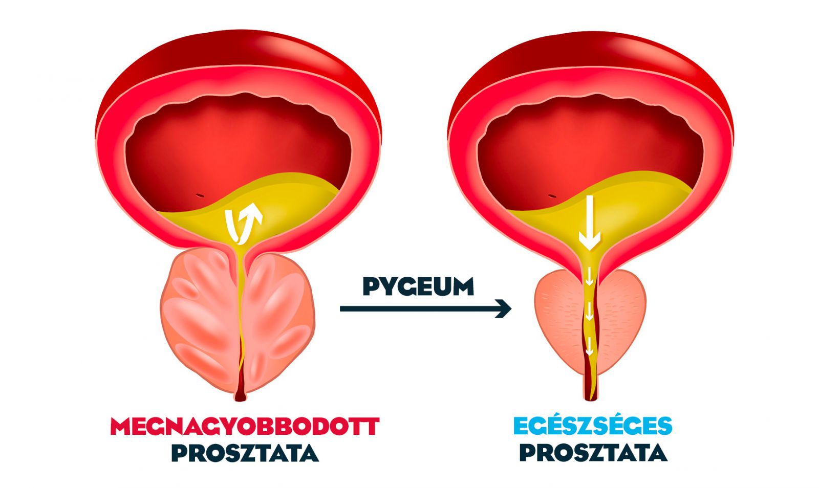 a gyertyák proprolist tesznek prosztatitisből a fibroza a prosztatában kalcinál